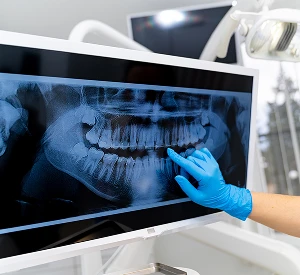 Digital Dental X-Rays